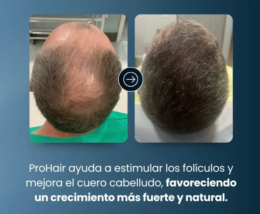 2 Cremas Tratamiento Alopecia Crecimiento Capilar